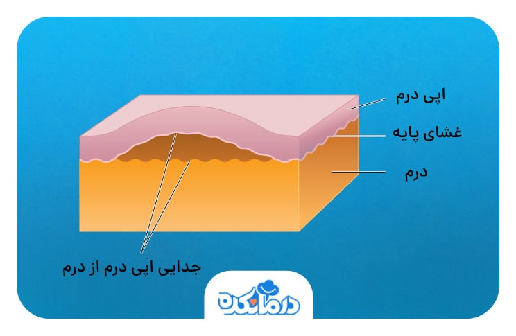 اینفوگرافیکی از ساختار پوست و جدایی اپی‌درم از درم.