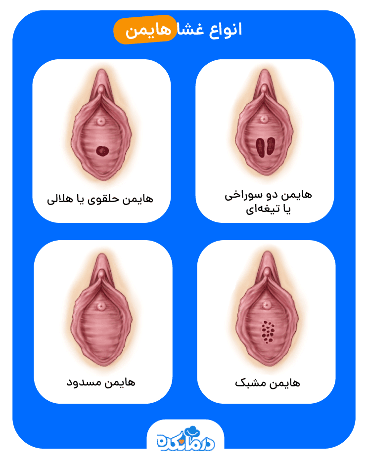 اینفوگرافی از انواع پرده بکارت