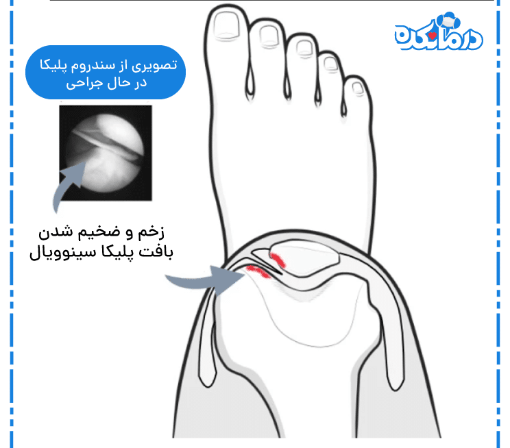 تصویری از سندروم پلیکا در حال جراحی