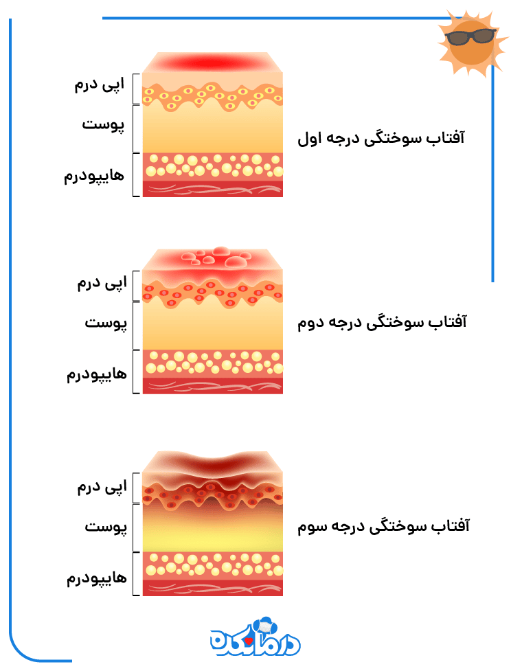 آفتاب سوختگی به دلیل واکنش سریع پوست به اشعه ماوراء بنفش خورشید است