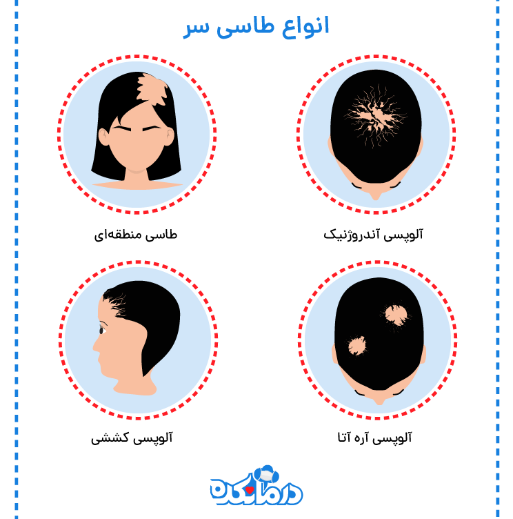 انواع تاسی سر یا بیماری آلوپسی