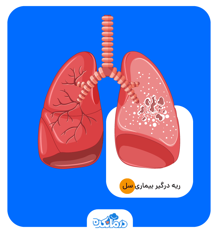 مقایسه ریه سالم با ریه مبتلا به بیماری سل