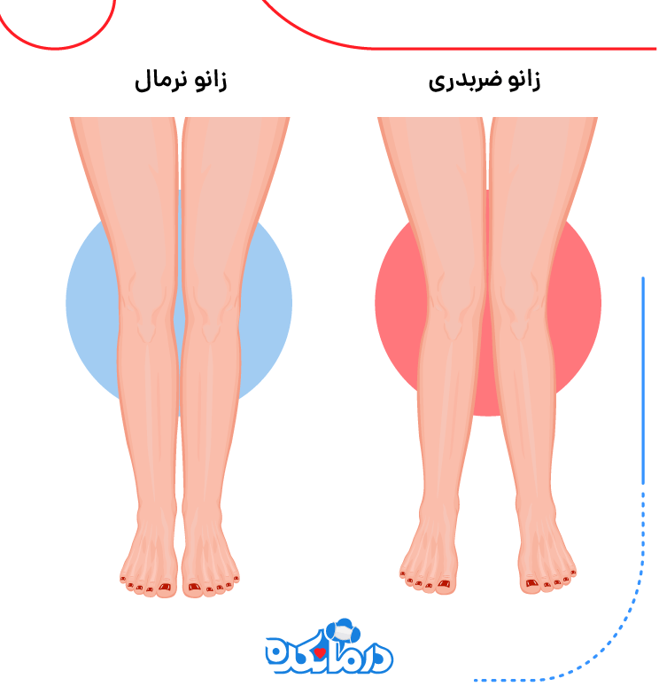 زانوی ضربدری موجب می‌شود تا زانوها از راستای طبیعی خارج شوند