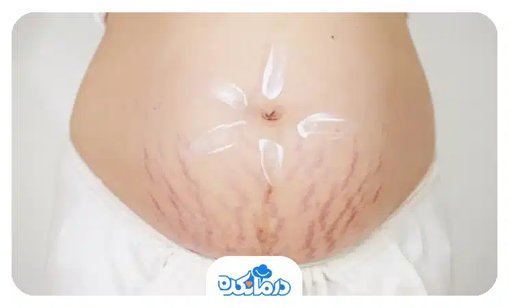   ترک پوستی در بارداری