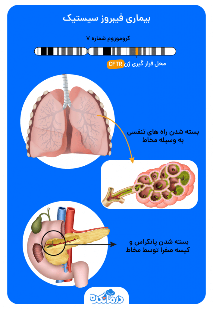 تصویری از بیماری فیبروز سیستیک در بدن انسان
