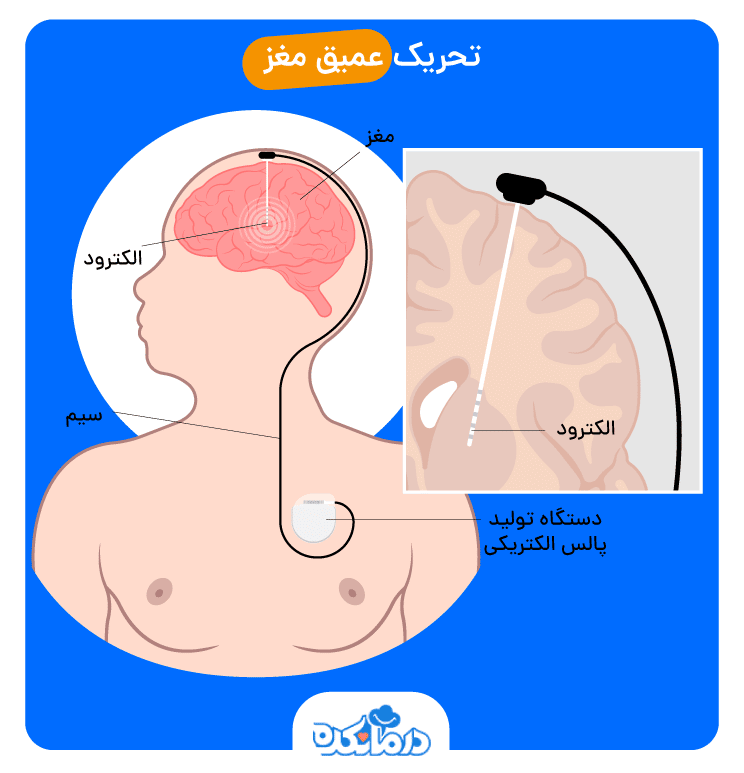 تصویر نشانگر نحوه به کارگیری روش تحریک مغزی عمیق