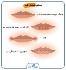 خشکی و ترک لب؛علت، علائم، انواع، عوارض، جلوگیری و درمان