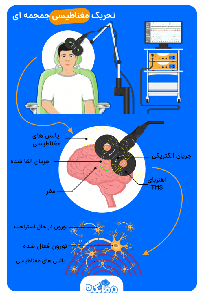 تصویر نحوه اثر گذاری روش تحریک مغناطیسی جمجمه ای یکی از روش‌های تحریک مغز