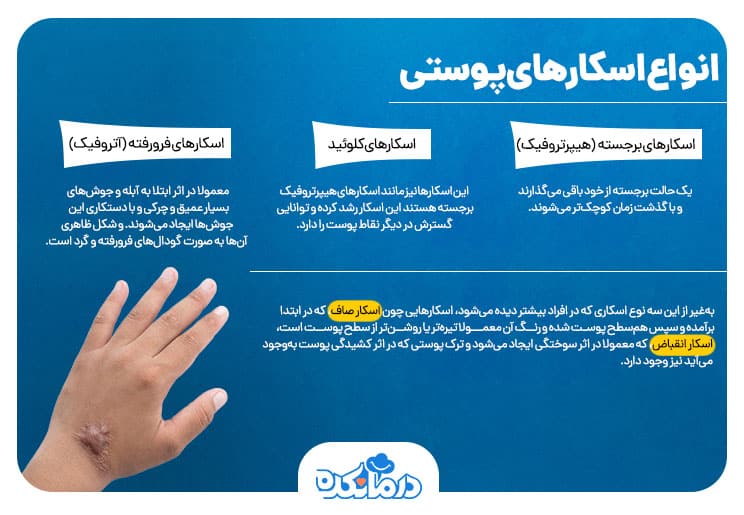 اینفوگرافیکی از انواع اسکار پوستی