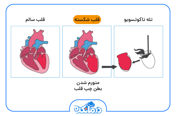 تصویر قلب سالم و قلب شکسته و مقایسه اندازه بطن چپ آن‌ها