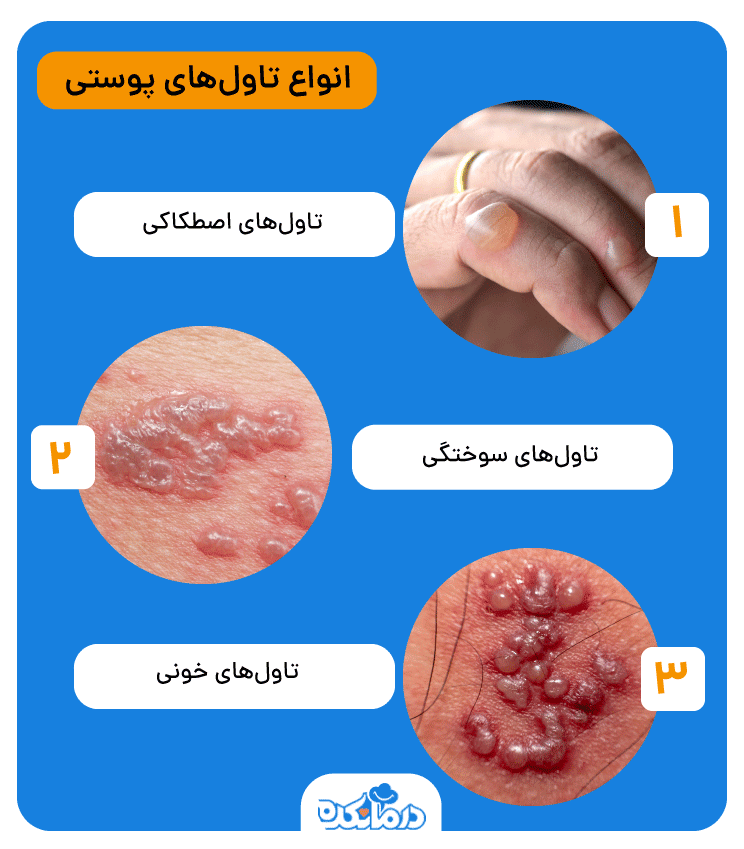 اینفوگرافیکی از انواع تاول‌های پوستی که می‌توانند اصطکاکی، تاول سوختگی و خونی  باشند.