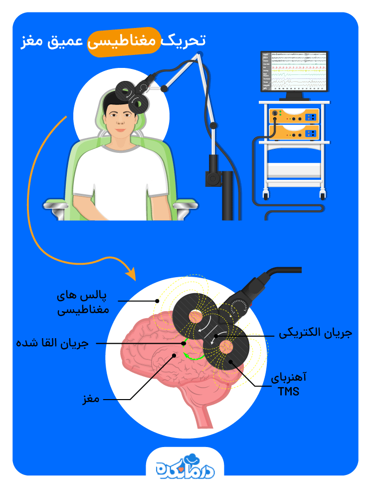 تصویر مراحل انجام تحریک مغناطیسی عمیق مغز