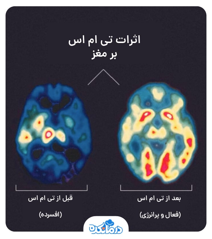 تصاویر مغزی قبل و بعد از انجام تی ام اس برای فرد افسرده
