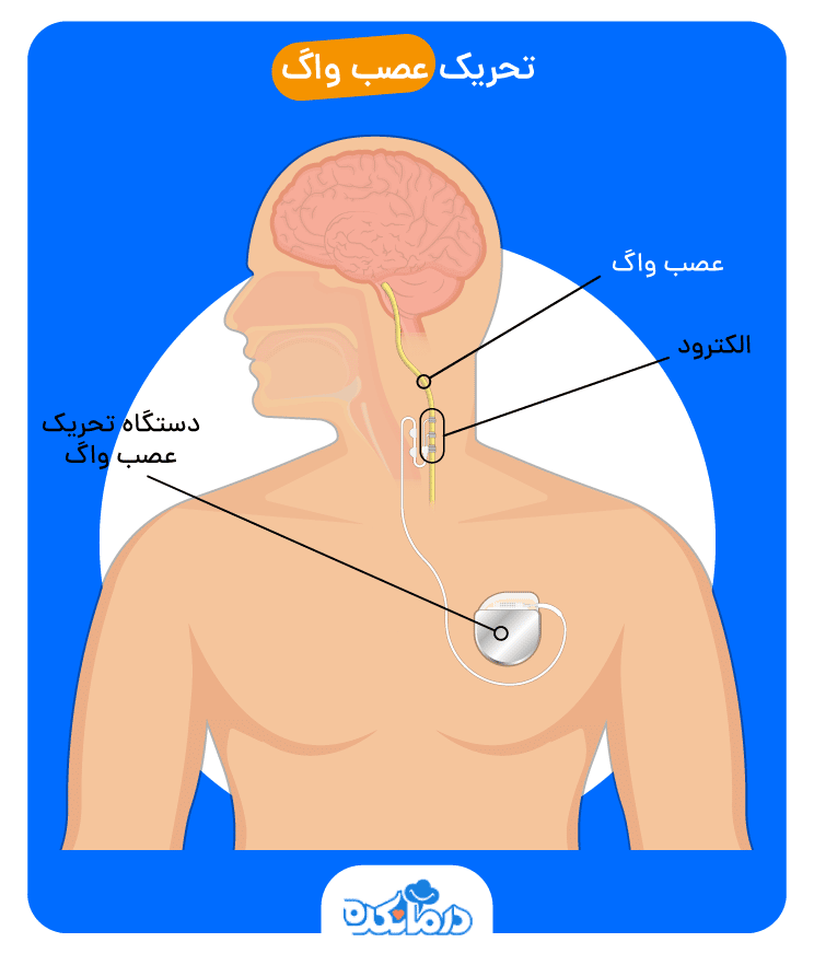 تصویر نشانگر محل عصب واگ و قرارگیری الکترود و دستگاه تحریک مغز عصب واگ
