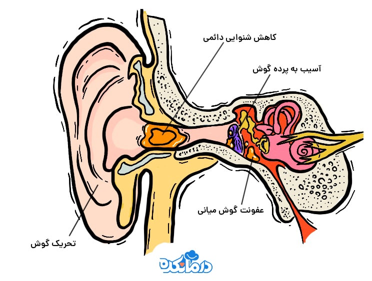 تصویری گرافیکی از گوش و عوارض تجمع جرم گوش