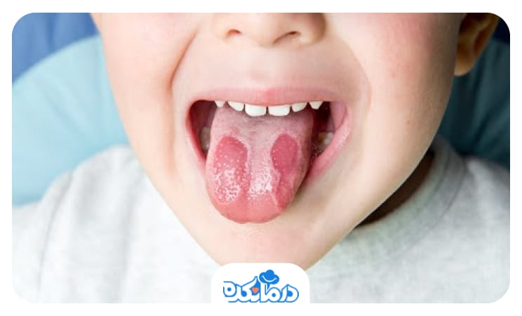 کودکی که به دلیل سوزش زبان، زبان خود را از دهان خارج کرده است