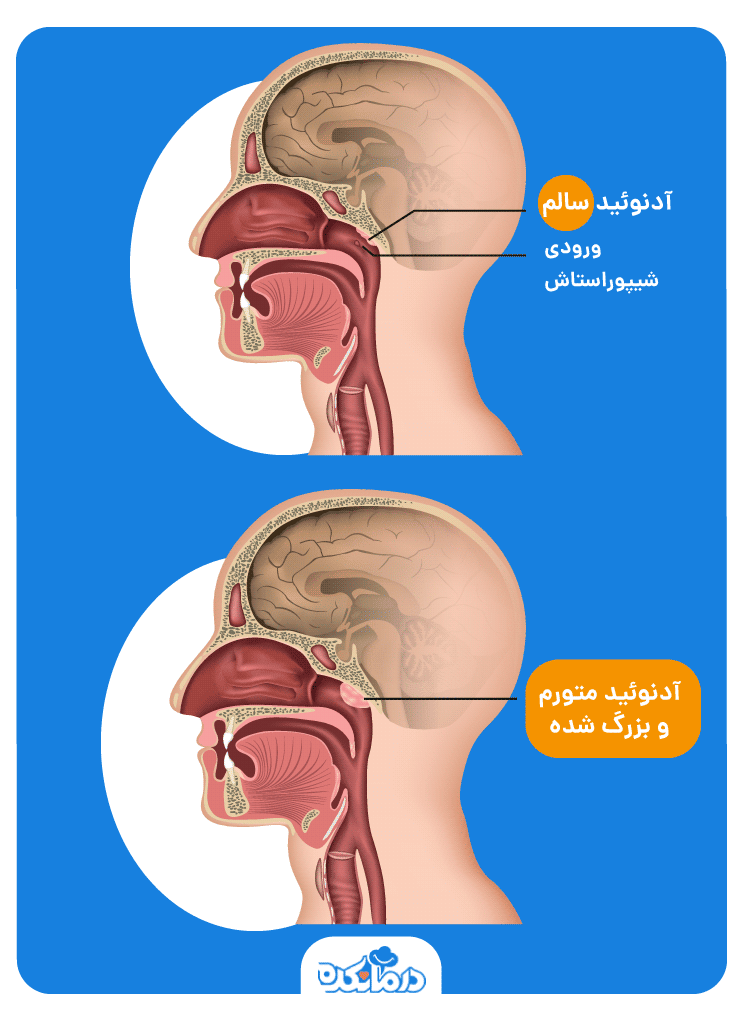 اینفوگرافیک آدنوئید سالم و متورم