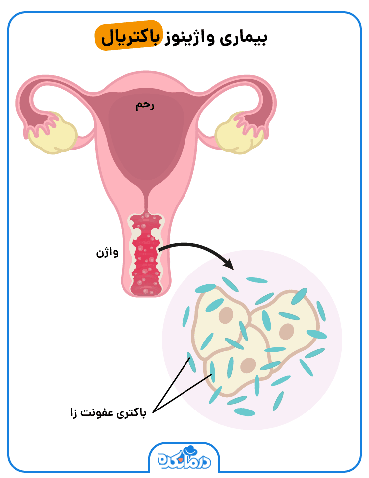 تصویری از بیماری واژینوز باکتریال در واژن خانم ها