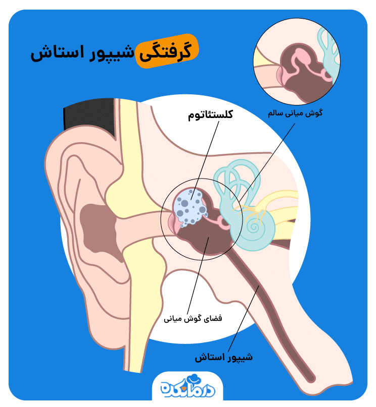 تصویر کلستئاتوم