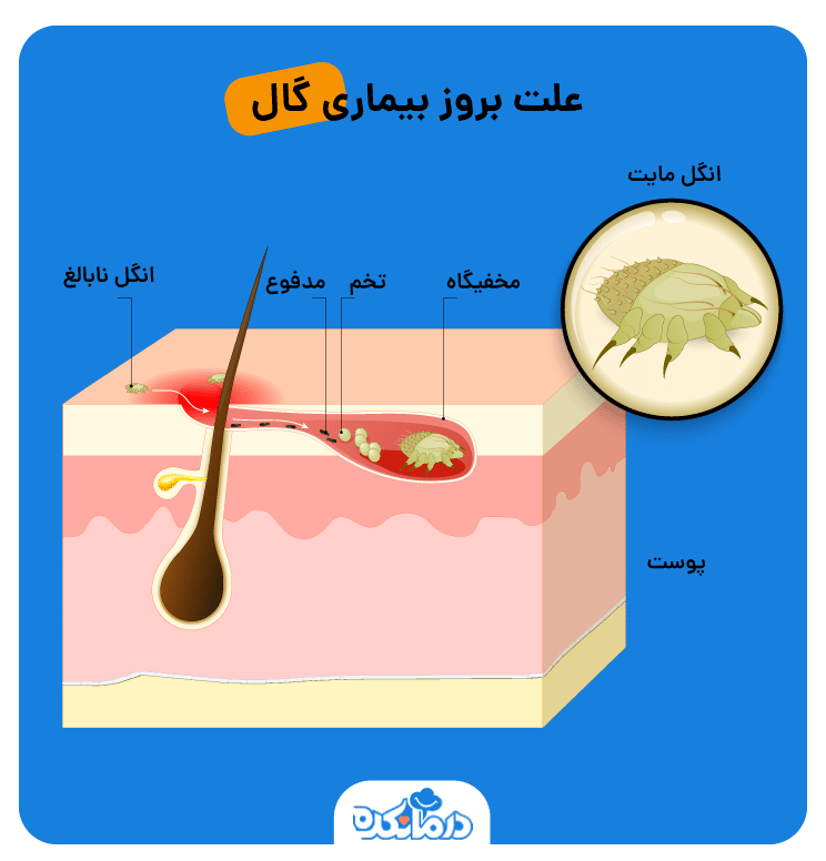 علت متعددی در شکل گیری بیماری گال در بدن وجود دارد که این عارضه بر روی پوست ایجاد می شود.