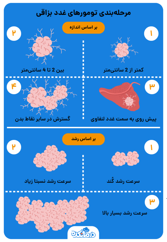 تصویر گرافیکی از مرحله‌بندی تومور غدد بزاقی بر اساس اندازه و سرعت رشد