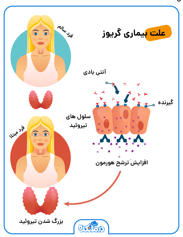 اینفوگرافی از علت بیماری گریوز