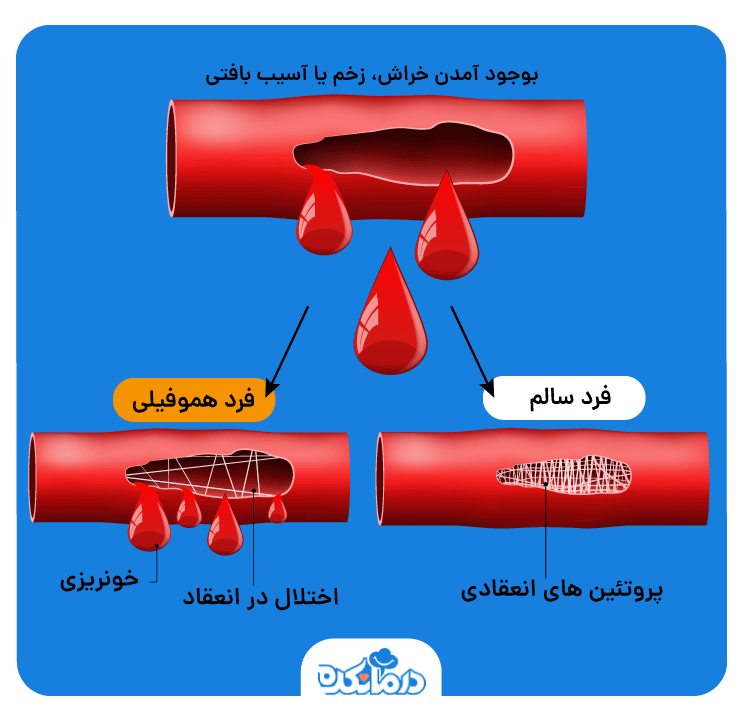 مقایسه فرآیند انعقاد خون در فرد سالم و فرد مبتلا به هموفیلی