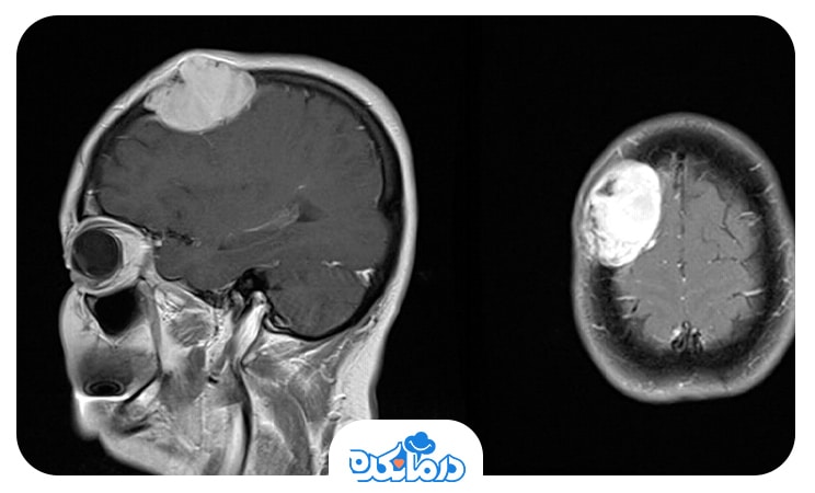 تصویری از تومور قاعده جمجمه