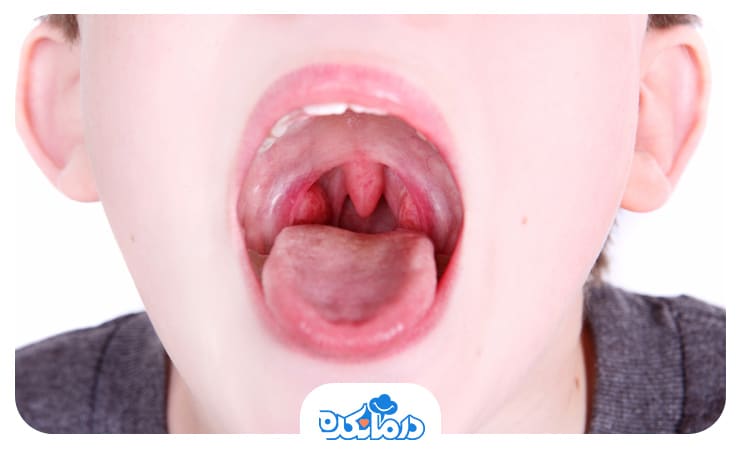 کودکی که دهان خود را باز کرده و لوزه او قابل مشاهده است