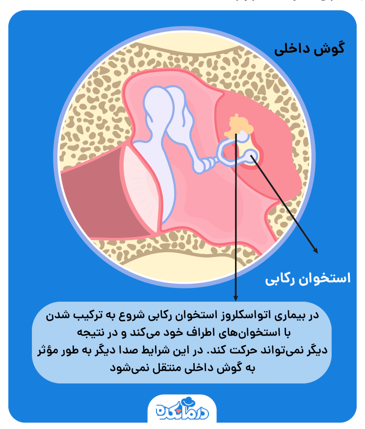 تصویری که در آن استخوان‌های گوش و شرایط بیماری اتواسکلروز را نشان می‌دهد.