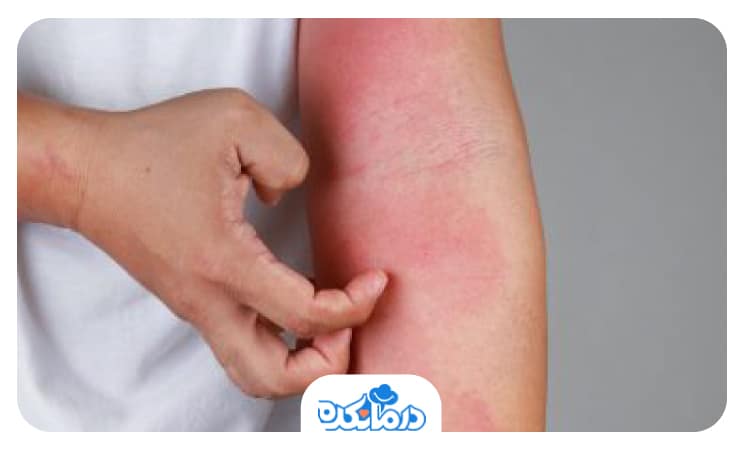 تصویر فردی که دچار سرخی پوست از نشانه‌های هشدار آلرژیک در مصرف فولیک اسید شده است