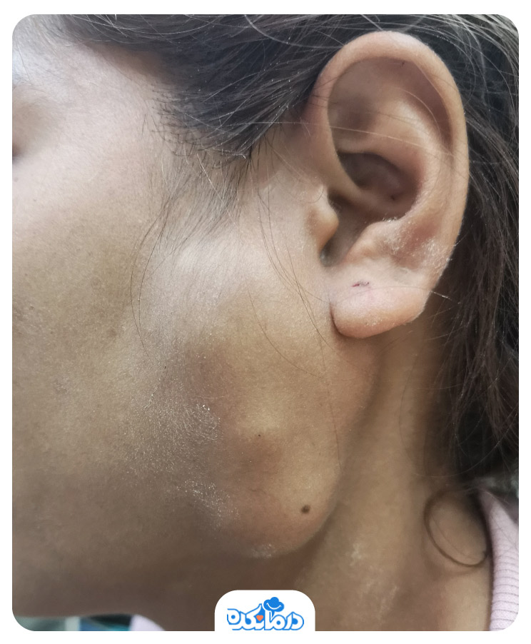 تصویری از صورت فرد مبتلا به تومور پاروتید که در بخش زیرین گوش خود دچار ورم شده است