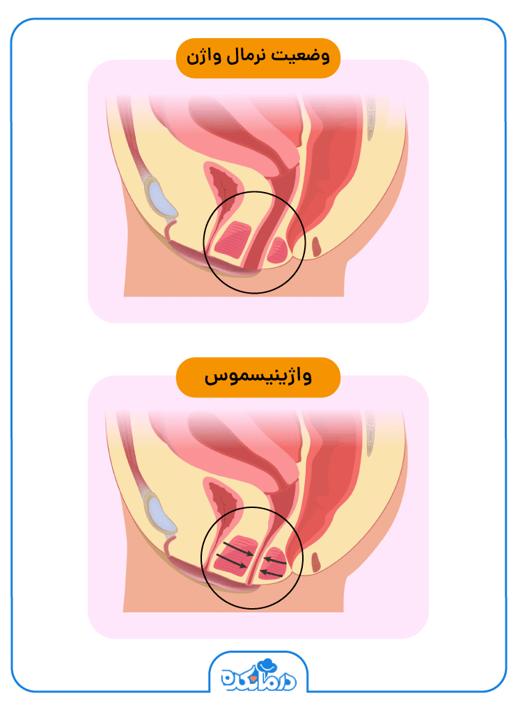 تصویری از آناتومی واژن در حالت نرمال و واژینیسموس