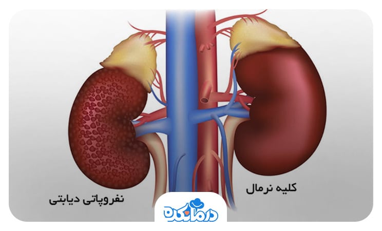 تصویری از کلیه سالم و کلیه مبتلا به نفروپاتی دیابتی