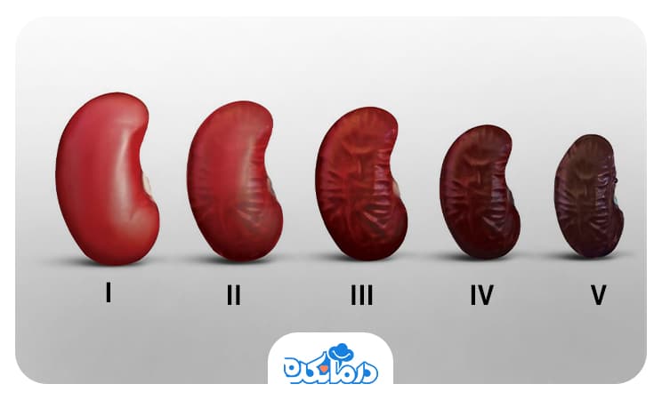 تصویری از 5 مرحله نفروپاتی دیابتی نشان‌دهنده تضعیف عملکرد