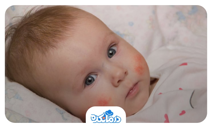 تصویر کودک دارای بثورات پوستی ناشی از بیماری پاروویروس