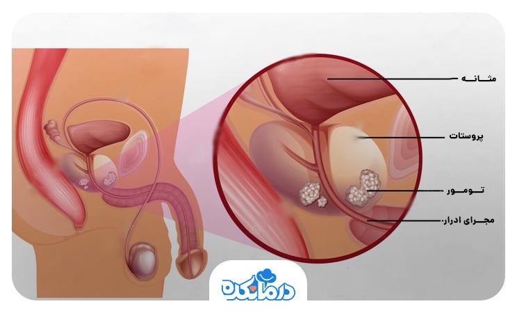 تصویر گرافیکی پروستات سرطانی نیازمند تست psa