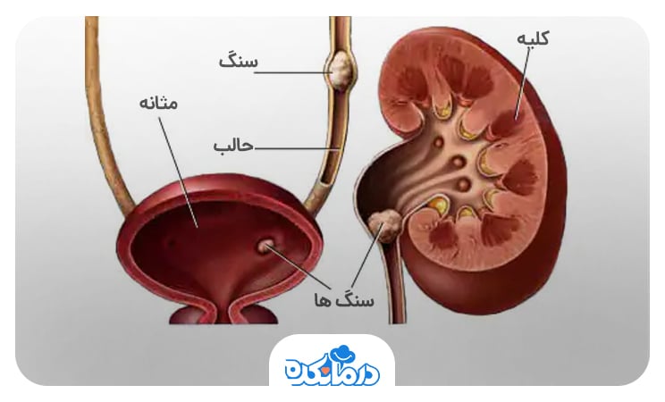 تصویر گرافیکی از کلیه‌ها و لوله‌های حالب دارای سنگ