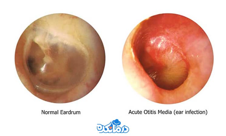 تصویری از گوش سالم و دارای عفونت