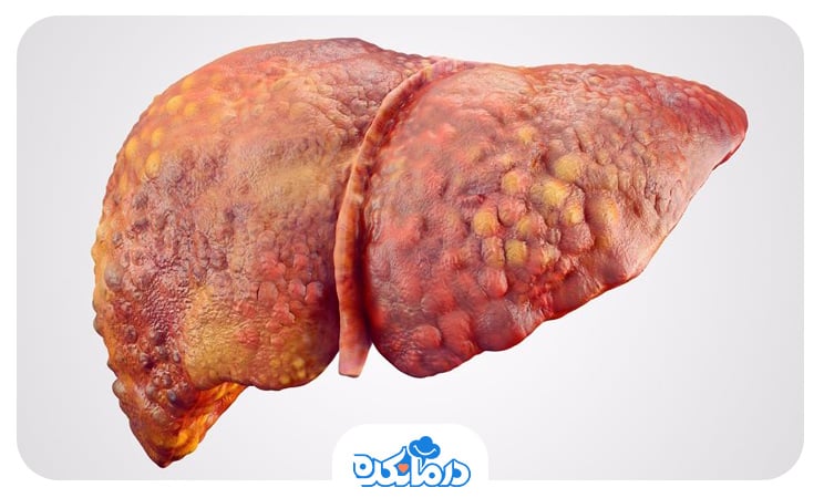 تصویری که سیروز کبدی را نشان می‌دهد. این بیماری باعث کاهش tibc در خون می‌شود.