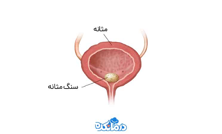 تصویر عکسی که در آن سنگ مثانه مشخص است.