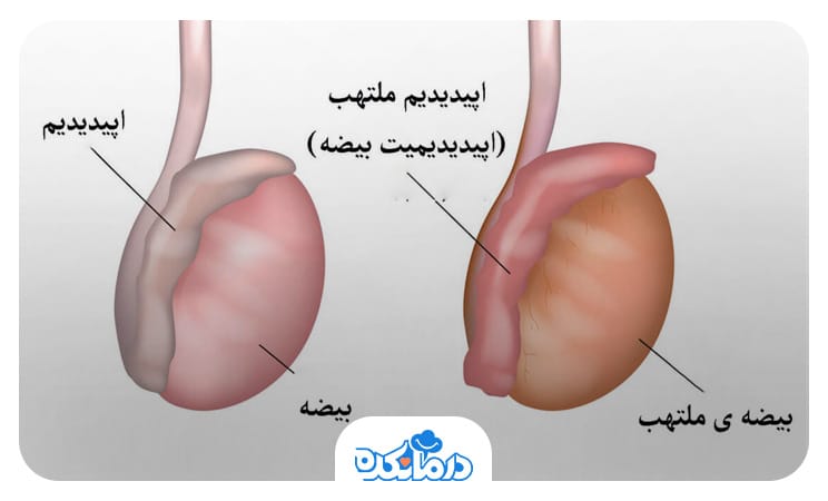 تصویر بیضه سالم و متورم دردناک