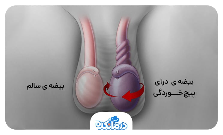 تصویر بیضه سالم و دارای پیچ‌خوردگی