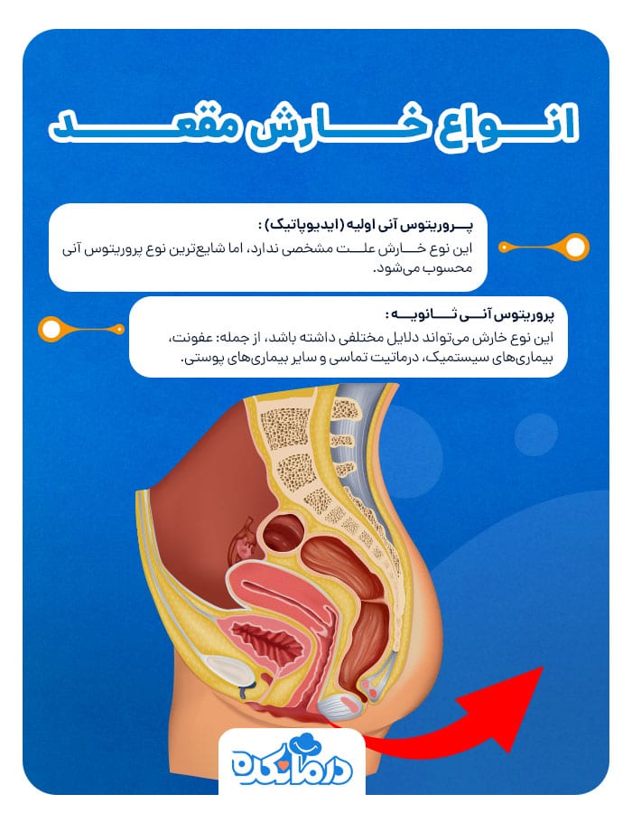 اینفوگرافی در مورد انواع خارش مقعد