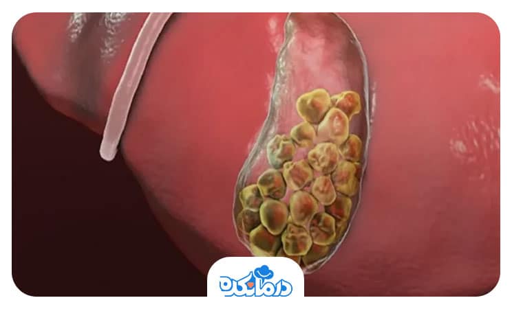 سنگ کیسه صفرا و هر آن چیزی که باید در مورد درمان آن بدانید