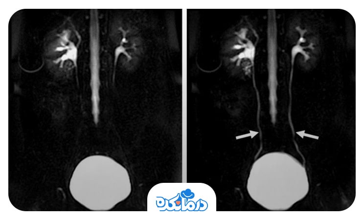 تصویری از نتیجه تست اوروگرافی ترشحی که وضعیت کلیه و حالب‌ها را نشان می‌دهد.