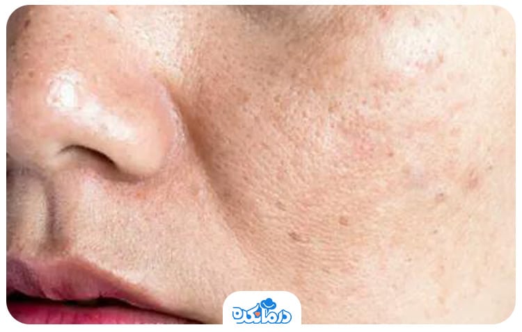 پوست صورت که دچار تیرگی شده است. تیرگی پوست می‌تواند به دلیل کمبود ویتامین باشد.