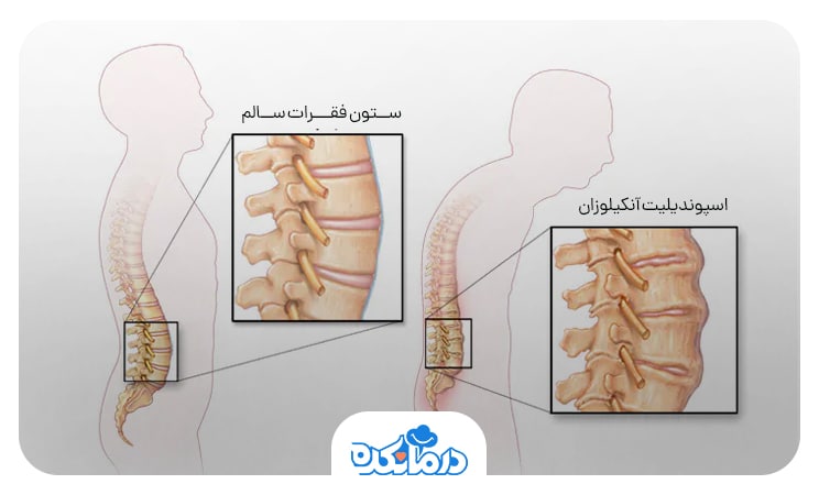 نمایی از ستون فقرات سالم و مقایسه آن با اسپوندیلیت آنکیلوزان