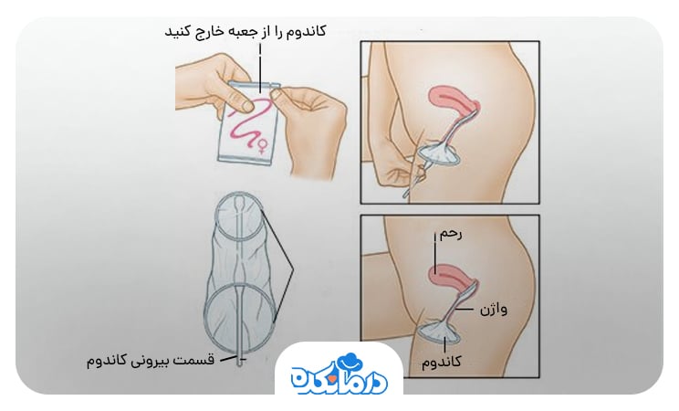 مراحل ورود کاندوم داخلی به واژن به شکل تصویری