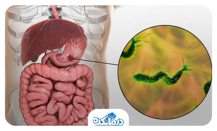 دستگاه گوارش شامل معده، روده و کبد و تصویری از باکتری هلیکوباکتر پیلوری در معده